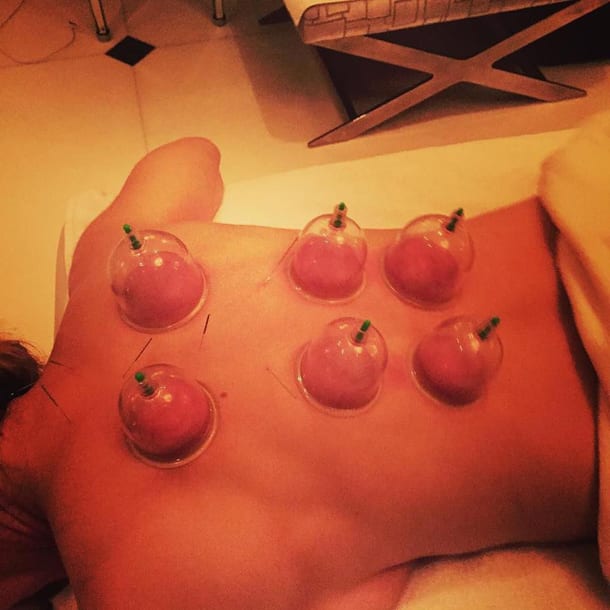 Cupping Therapy: anche Madonna stregata dal trattamento olistico