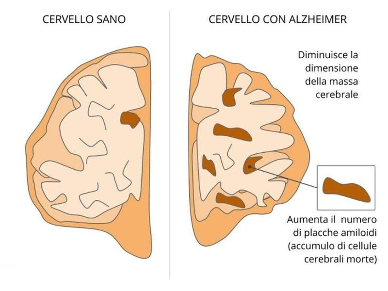 Alzheimer: pet e una puntura lombare come nuovo protocollo efficace