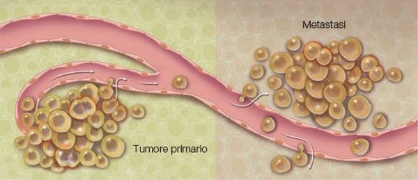 Melanoma, scoperta l'origine delle metastasi: così si potranno bloccare