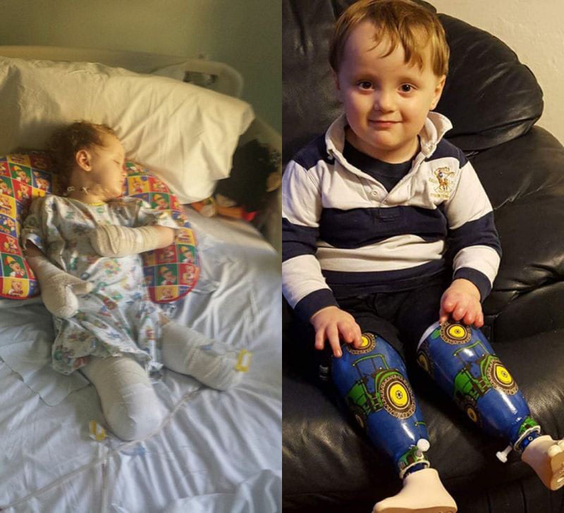 Diagnosi sbagliata: bimbo di 3 anni costretto a vivere senza gambe né dita