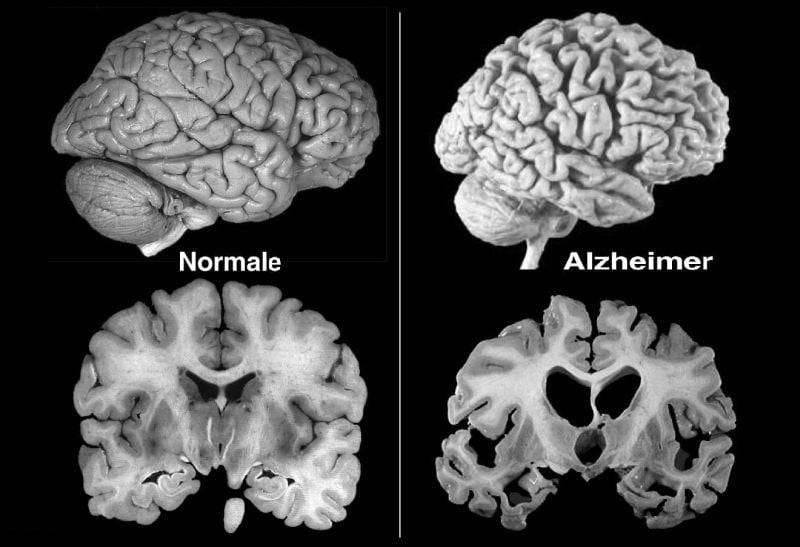 L'Alzheimer ha i mesi contati: un nuovo farmaco lo abbatte in un anno