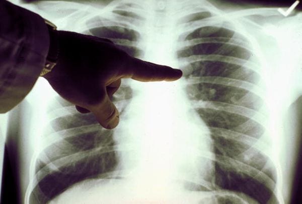 Tumore ai polmoni: trovato il farmaco che lo 'scioglie' ed evita la chemio