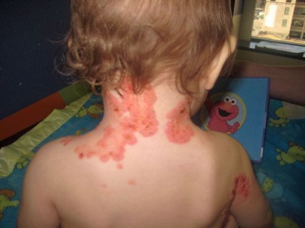 Rara malattia della pelle: a 5 anni niente abbracci né giochi al sole