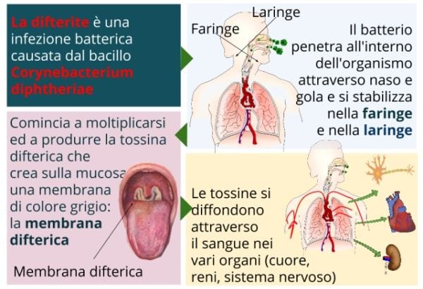 Allarme difterite in Italia: panico per le nuove epidemie