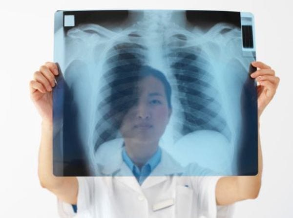Tumore al polmone, scoperta choc: potrebbe causarlo un virus