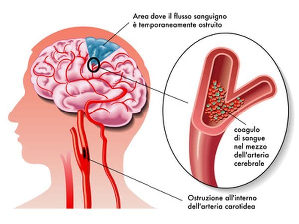 Ictus: scoperto l'enzima killer da cui ha origine. Come bloccarlo?