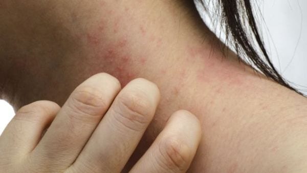 Cura l'eczema con metodi naturali: si inietta la curcuma e muore