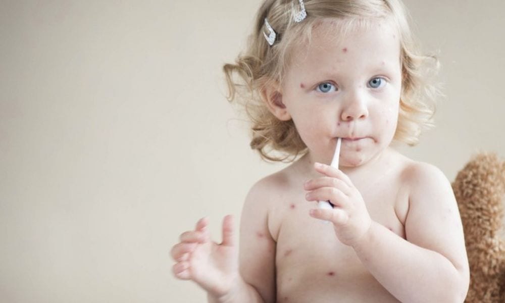 Morbillo: lettera del bambino malato ai genitori che non vaccinano i figli