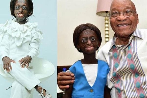 Addio Ontlametse: muore la ragazza intrappolata nel corpo di un’anziana