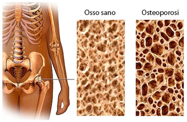 Osteoporosi: 1 su 8 ne soffre ma la trascura. Mortalità e cause
