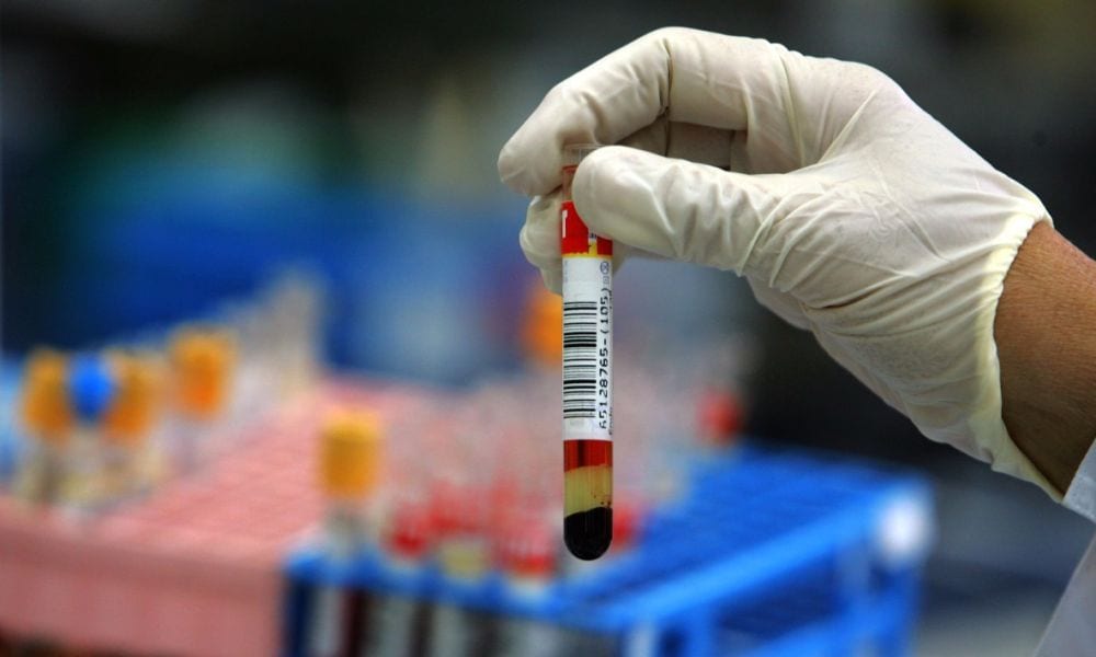 Test del sangue individua il tumore: la svolta che salverà molte vite