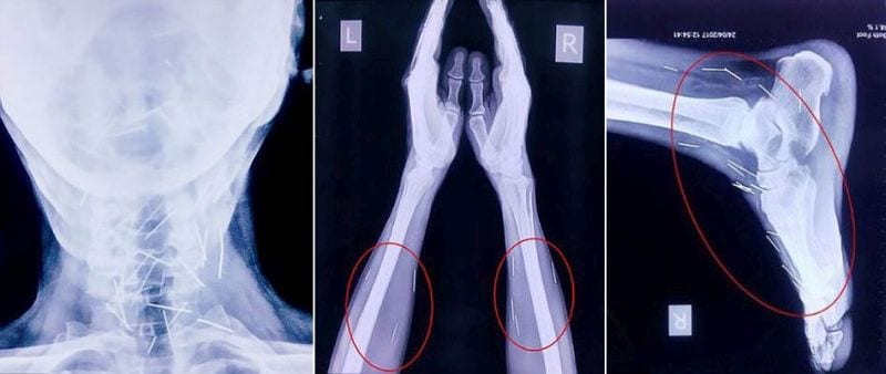 In ospedale per un dolore al piede: la lastra trova 70 spilli nel corpo