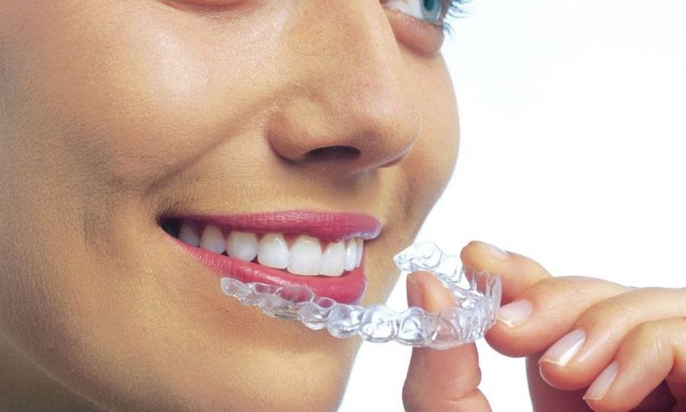 Bite per denti: cos'è e come funziona