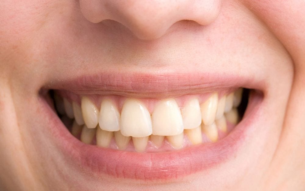 Denti gialli: come risolvere con rimedi naturali