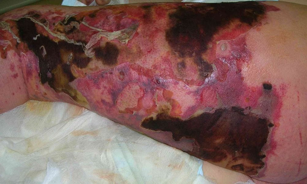 Muore per un bagno in mare dopo il tatuaggio: virus infetta la ferita