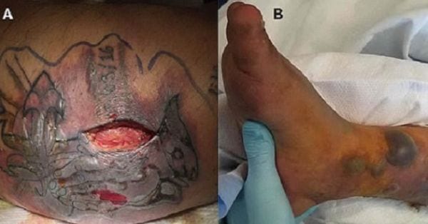 Muore per un bagno in mare dopo il tatuaggio: virus infetta la ferita