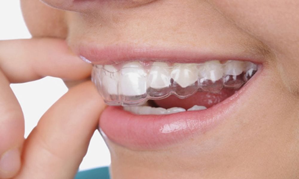 Mascherine denti: come funzionano