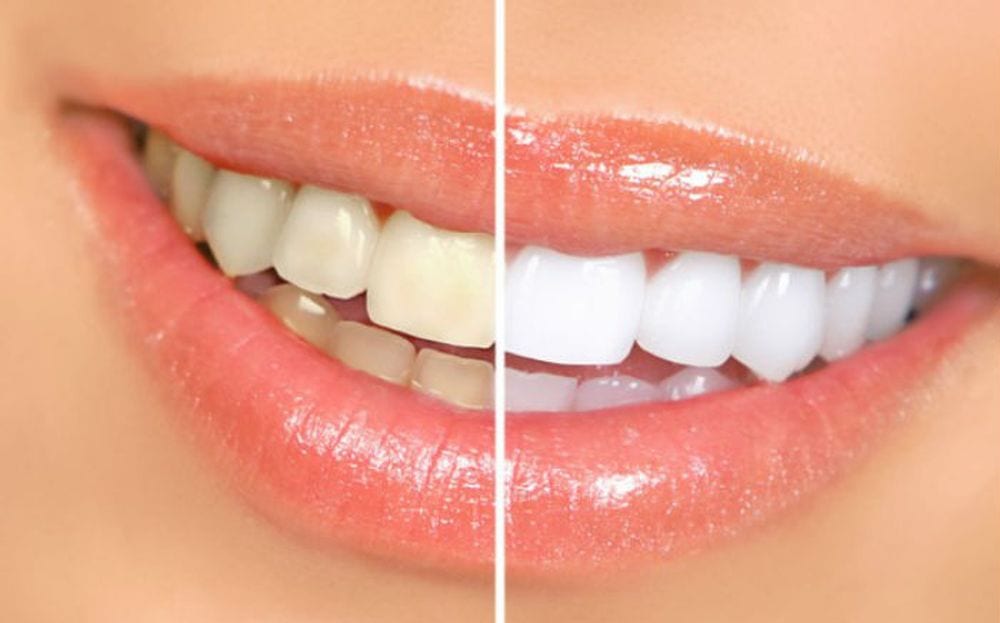 Usare l'acqua ossigenata per sbiancare i denti: funziona o no?