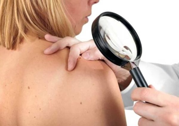 Tumore alla pelle: farmaco contro l’ipertensione risolve 8 casi su 10