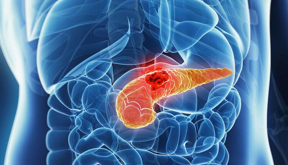 Tumore al pancreas +59%: fattori di rischio e abitudini da correggere