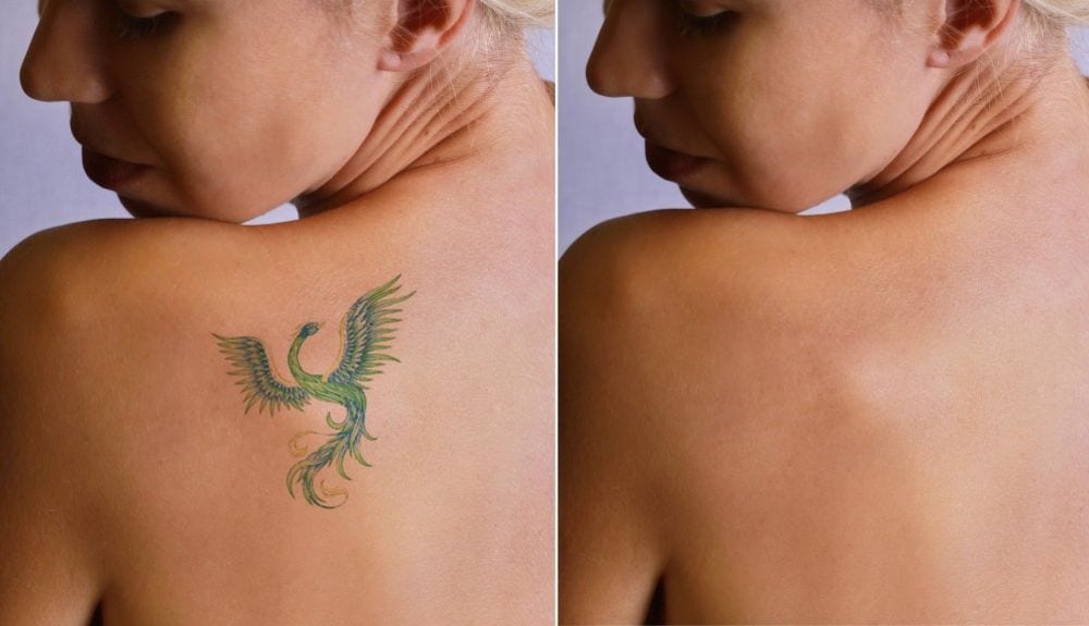 Boom rimozione dei tatuaggi: dolore, costi e perché non tutti vanno via