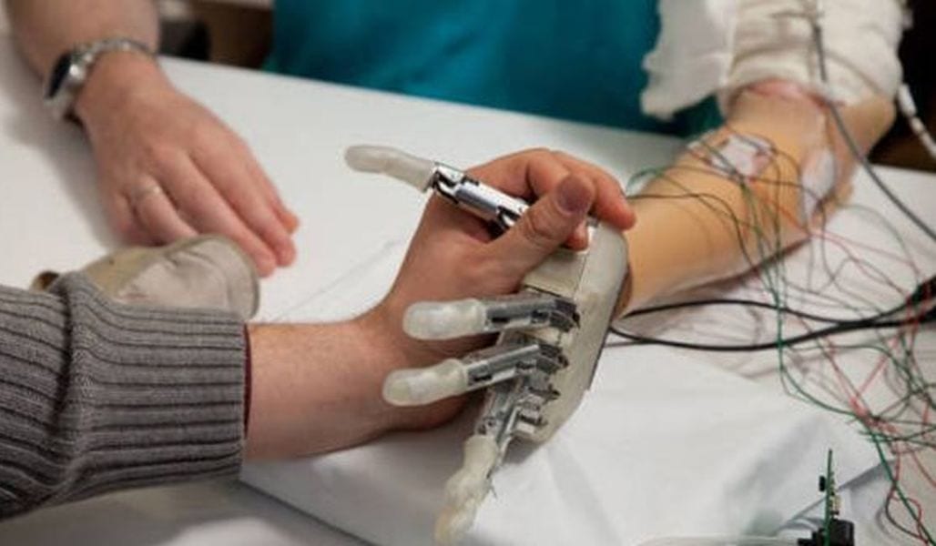 Mano bionica completa di tatto: la prima impiantata al Gemelli di Roma