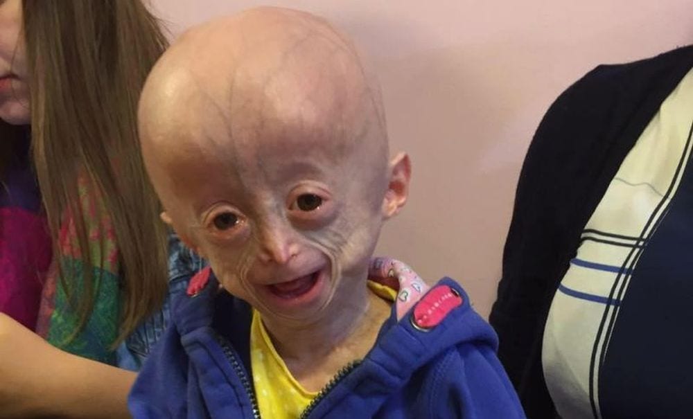 Morta Lucy Parke, la bambina col corpo da vecchia per la Progeria