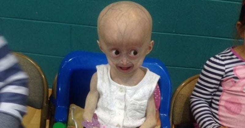 Morta Lucy Parke, la bambina col corpo da vecchia per la Progeria