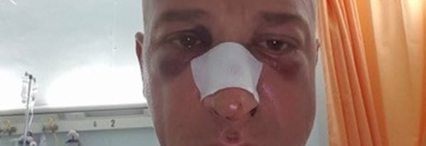 Reazione allergica all'antibiotico: uomo cade e si rompe naso e denti