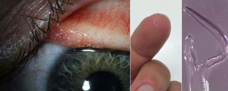 Ha un'infezione all'occhio: i medici le estraggono 14 vermi [FOTO]