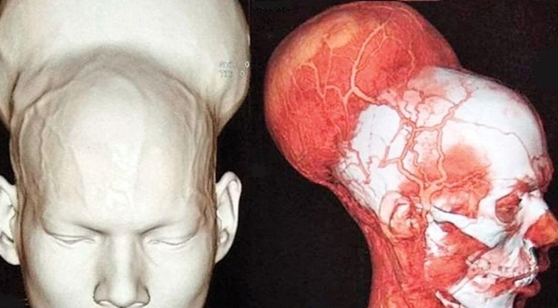 Rimosso il più grande tumore al mondo: 1,8 chili nel cervello