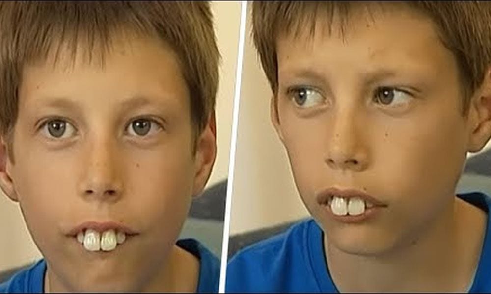 Bambino coniglio veniva bullizzato per i denti: è arrivata la sua rivincita [VIDEO]