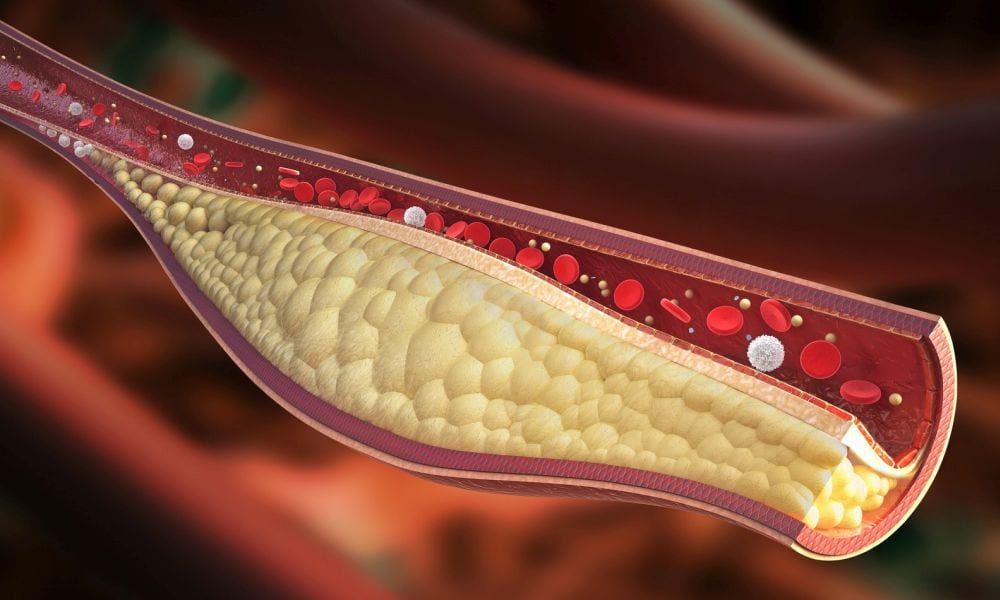 Colesterolo: nuova puntura lo tiene sotto controllo tutta la vita