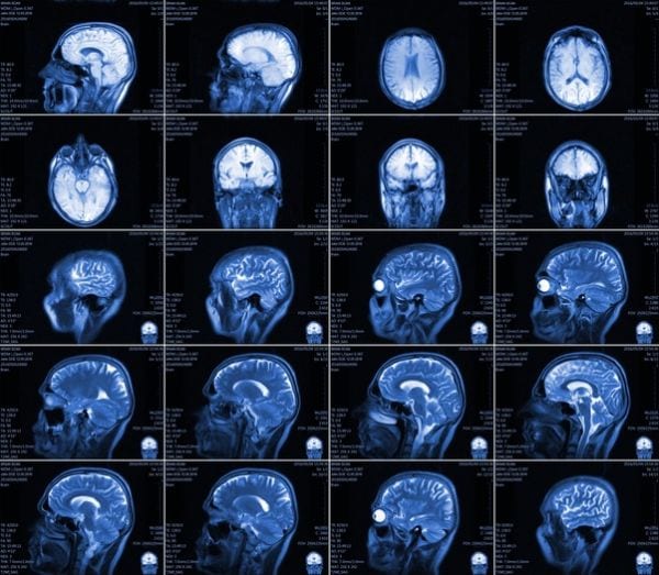 Tumore: scoperto cosa fa partire le metastasi al cervello