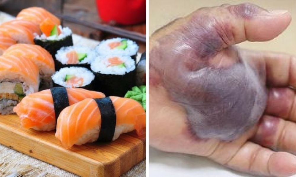 Mangia sushi: ciò che accade alla mano costringe all'amputazione