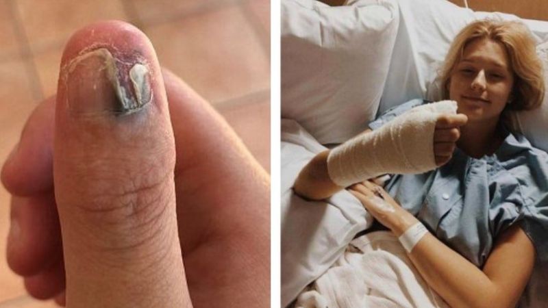 Si mangia le unghie per anni: contrae un tumore e deve amputare il dito